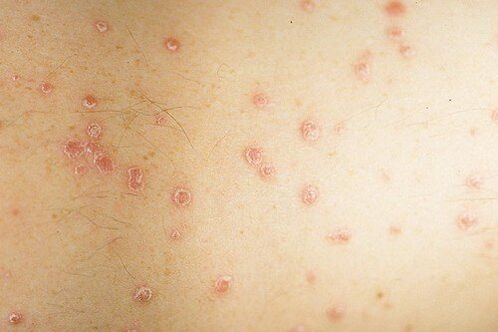 Early photos of psoriasis