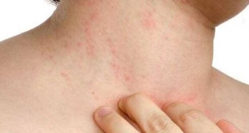 Itchy skin at the beginning of psoriasis