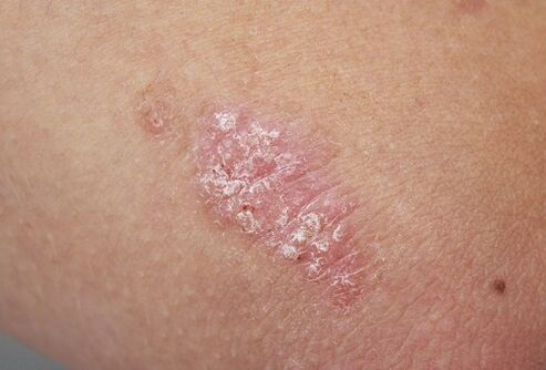 Psoriasis spots on the skin