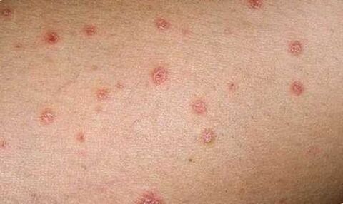 The initial appearance of psoriasis on the skin