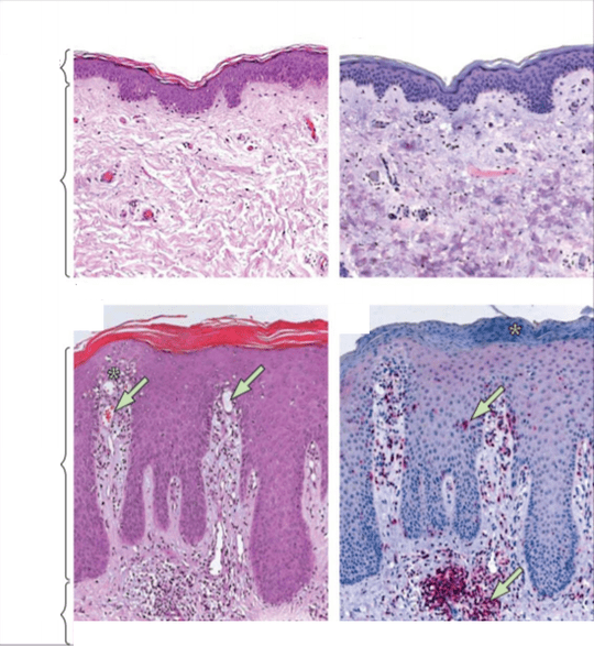 Normal and psoriatic skin