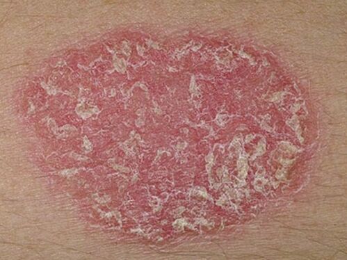What psoriasis looks like