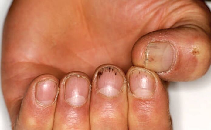Bleeding under the nails for psoriasis