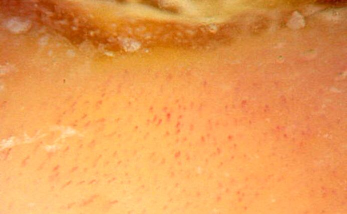 Dermoscopy magnified 40 times to confirm psoriasis