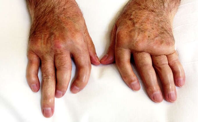 Disabling arthritis in psoriasis