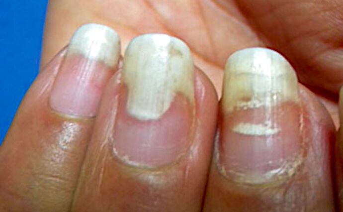 Onychomycosis and diphtheria after manicure
