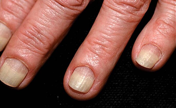 Onychomycosis spread from the edge of the nail to the wrinkles of the nail