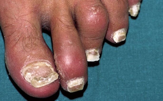 Psoriasis with nail involvement and toe joint inflammation (arthritis)