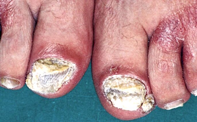 Severe hypokeratosis and psoriasis plaques in the toes