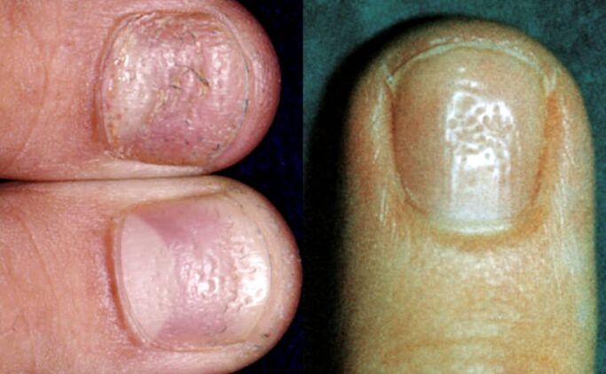 Symptoms of thimble-multiple depressions on the surface of the nail plate