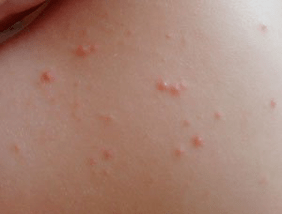 Identify the symptoms of rash and psoriasis