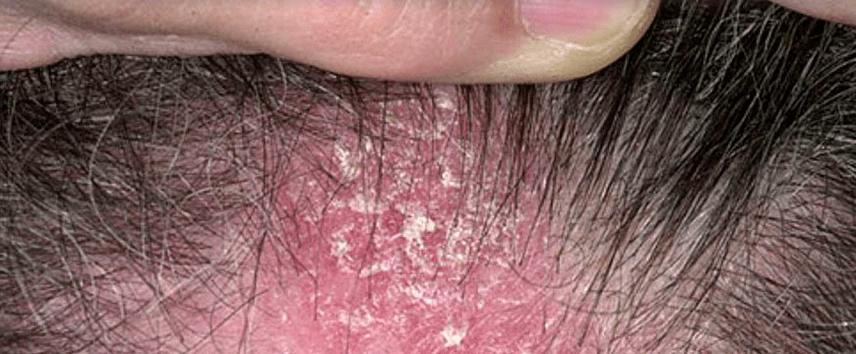 Psoriasis skin lesions on the scalp